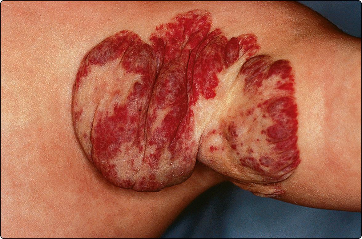 Fig 67.2, Infantile haemangioma in the left axilla showing signs of spontaneous involution.