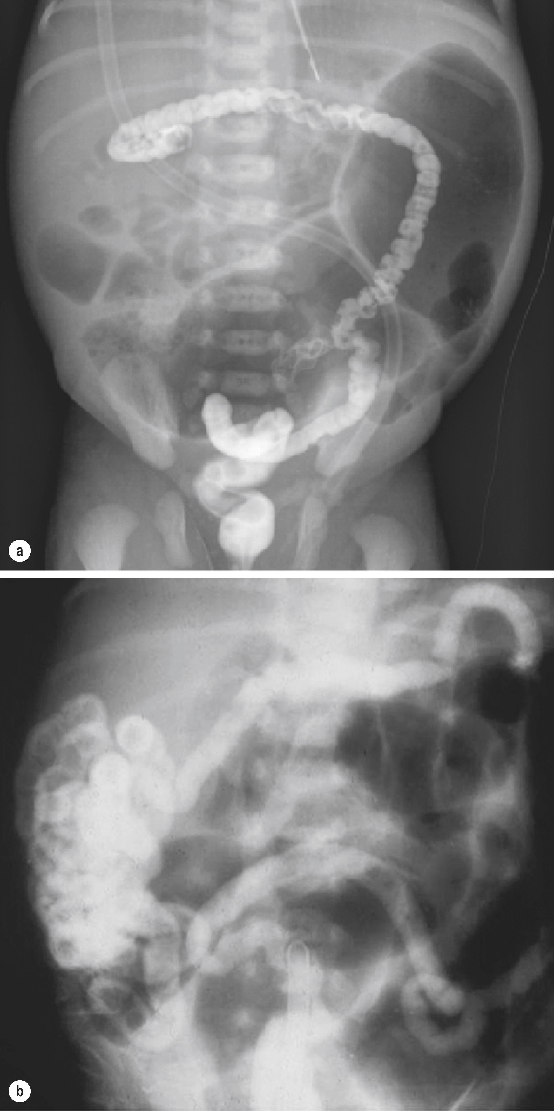 Figure 18.2, Water-soluble contrast enemas of infants with distal bowel obstruction. (a) Meconium ileus, showing a microcolon, dilated proximal small bowel and a soap-bubble appearance in the right lower quadrant. (b) Ileal atresia, showing a microcolon, contrast entering the distal small bowel but dilated proximal small bowel without contrast. (c) Hirschsprung disease: lateral film showing a contracted distal rectum with dilated bowel proximally.