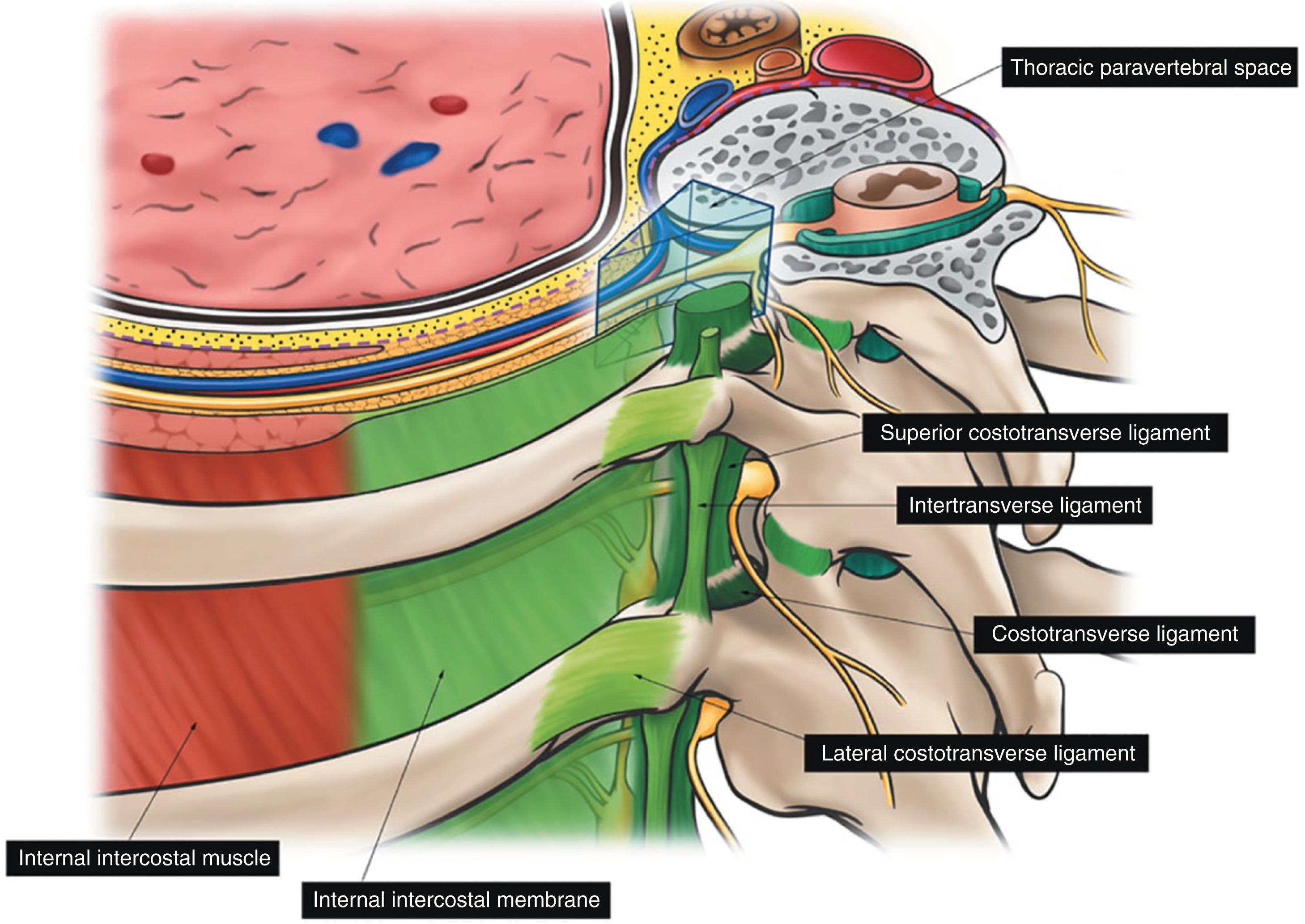 Figure 30.2, Anatomy of the thoracic paravertebral space showing the various paravertebral ligaments and their anatomical relations to the thoracic paravertebral space.