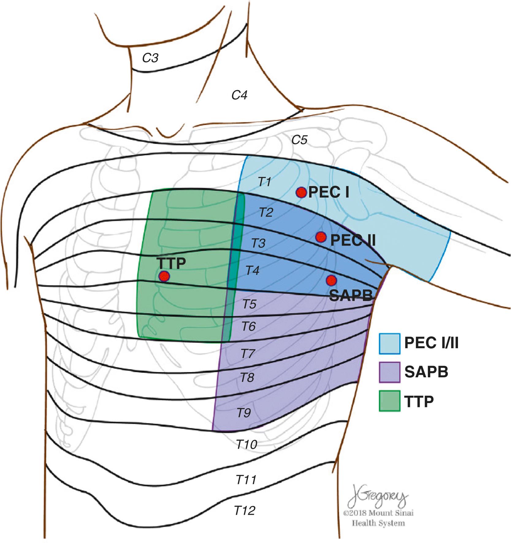 Figure 30.4, Illustration of the chest wall anatomy, including suggested regional block insertion sites and respective area and dermatomal distribution of expected sensory block. PEC , Pectoral nerve block; SAPB , serratus anterior plane block; TTP , transverse thoracic plane block.
