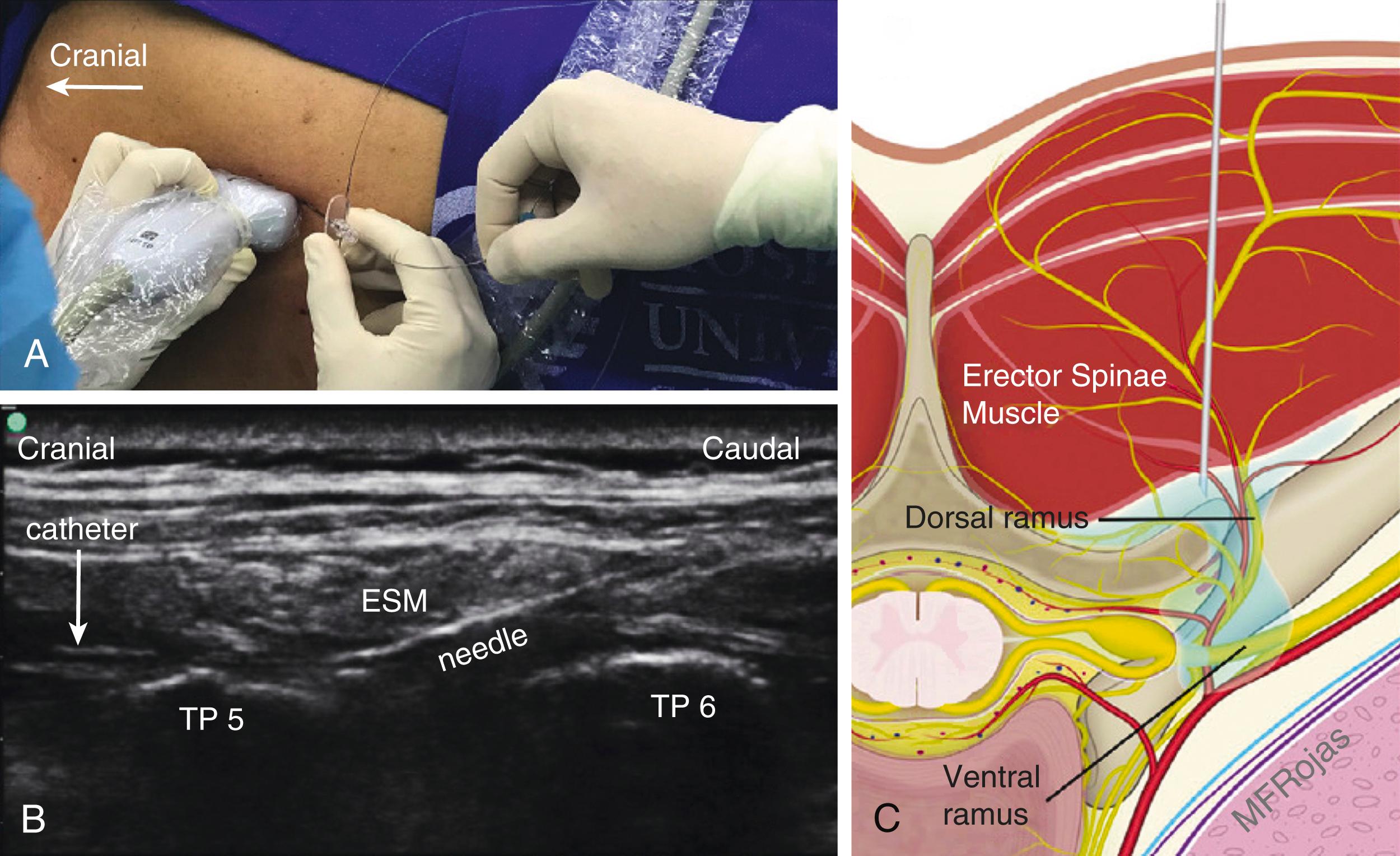 Figure 30.5, Erector spinae plane block. (A) Left lateral decubitus position. (B) Ultrasound imaging. (C) Illustration. ESM , Erector spinae muscle; TP , transverse process.