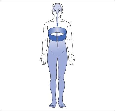 Figure 68-1, Typical pattern of at-level neuropathic pain following spinal cord injury (T4 neurological level).