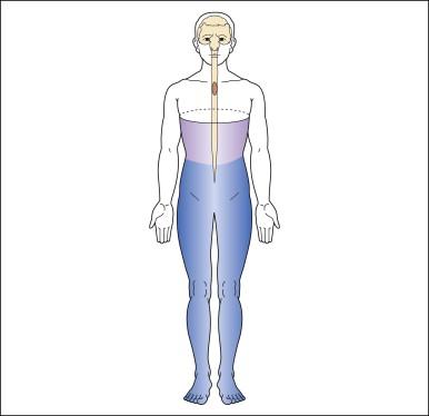 Figure 68-2, Typical pattern of below-level neuropathic pain following spinal cord injury (T4 neurological level).