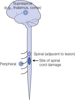 Figure 68-3, Possible sites and causes of abnormal neuronal activity that may be responsible for pain following spinal cord injury.
