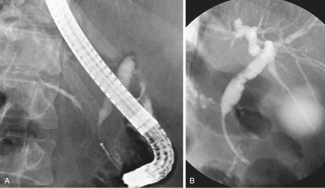 FIG 63.2, A, Stenosis of both the common bile duct and the pancreatic duct, also called a double-duct sign, caused by pancreatic adenocarcinoma. B, A 10-Fr, 9-cm plastic endoprosthesis inserted through a distal bile duct stricture.