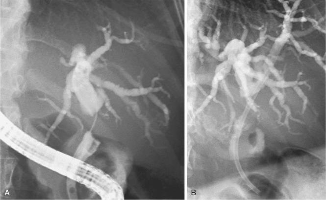 FIG 63.4, A, Mid–common bile duct stricture caused by gallbladder carcinoma. B, An 11-cm, 10-Fr plastic endoprosthesis has been inserted.