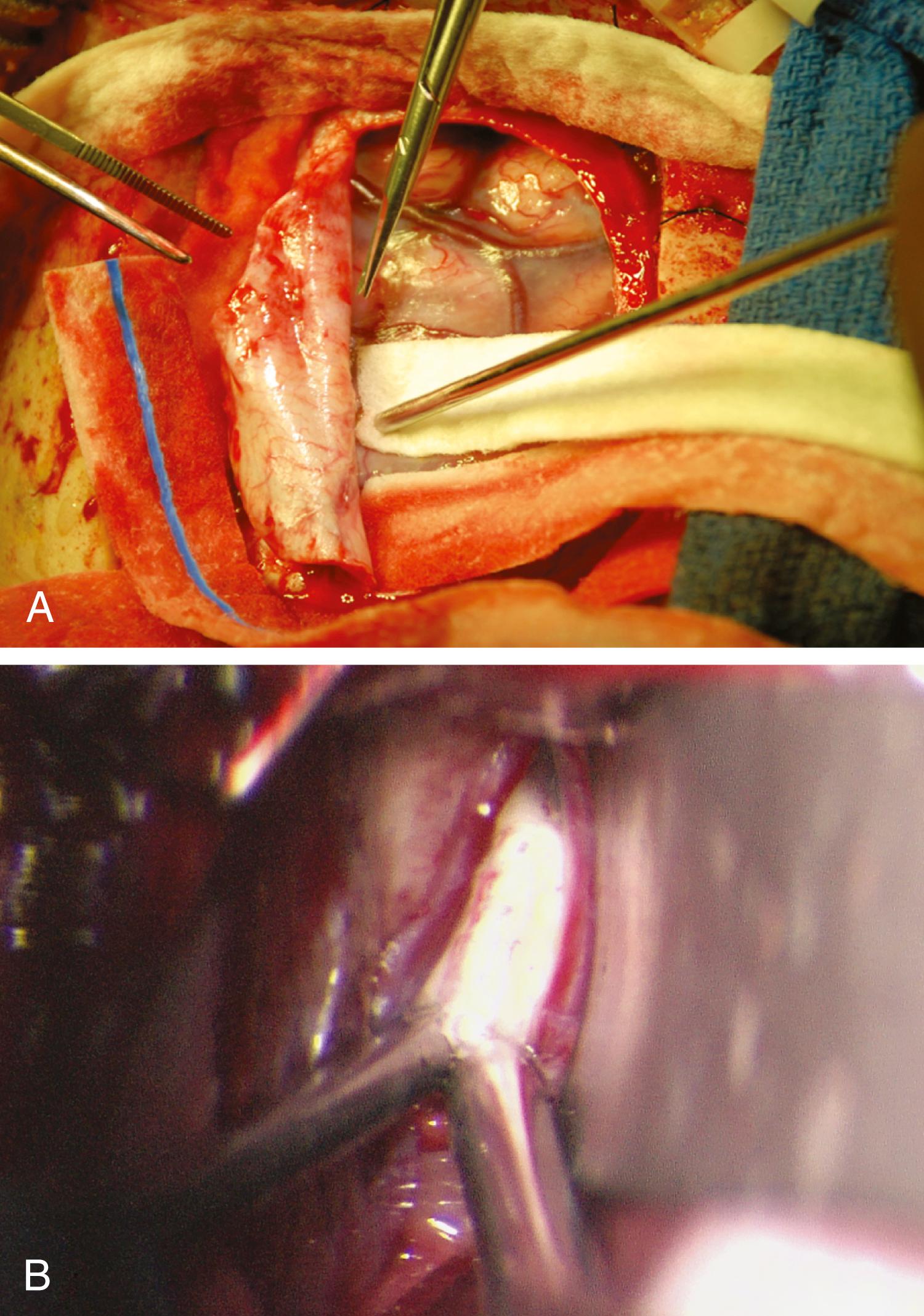 Figure 96.1, (A) The craniotomy is usually located with the midpoint just anterior to the coronal suture and extending just lateral to midline on the contralateral side. The location of the craniotomy may be adjusted to avoid exposure over cortical veins. Once the craniotomy is completed, the dura is opened and retracted toward the sinus. (B) The interhemispheric fissure is entered and carefully divided. A self-retaining retractor may be useful. During the approach, care is taken to identify the callosal marginal arteries and then the pericallosal arteries. If adhesions between the frontal lobes must be divided, it is important that the division stay medial to the arteries to avoid disrupting small perforators. Here, the distinct shiny white appearance of the corpus callosum makes it readily identifiable.