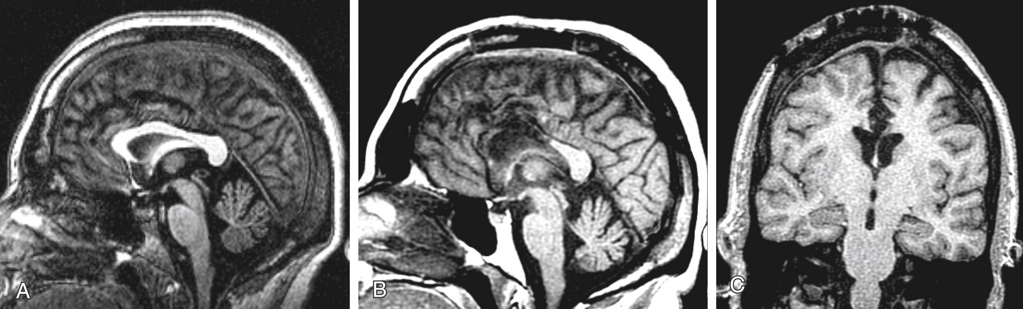 Figure 96.2, (A) Preoperative T1-weighted magnetic resonance imaging showing the corpus callosum on sagittal view. (B–C) Postoperative T1-weighted magnetic resonance imaging showing anterior corpus callosotomy on sagittal view (B) and coronal view (C).