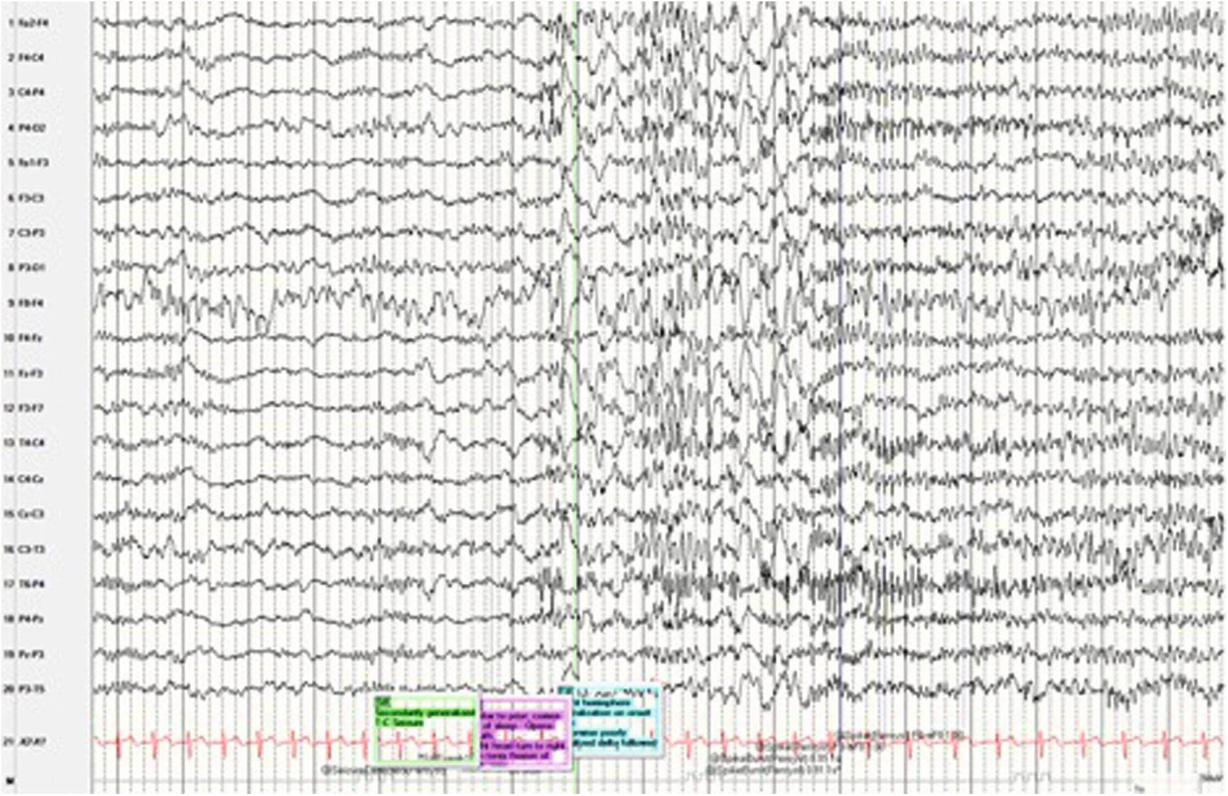 Figure 96.3, Electroencephalogram showing right hemisphere lateralization on onset with secondary generalization.