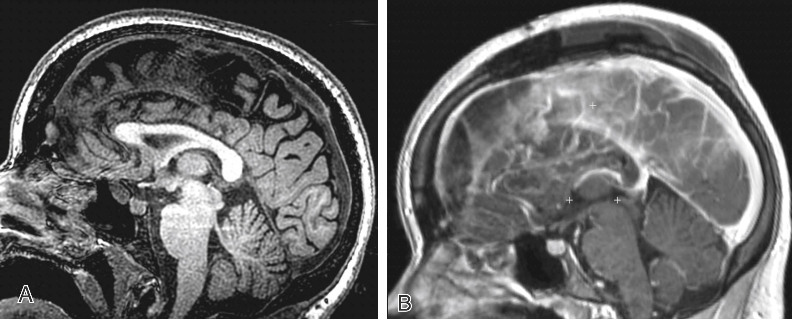 Figure 96.4, (A) Preoperative T1-weighted magnetic resonance imaging showing the corpus callosum on sagittal view. (B) Postoperative T1-weighted magnetic resonance imaging showing complete corpus callosotomy on sagittal view.