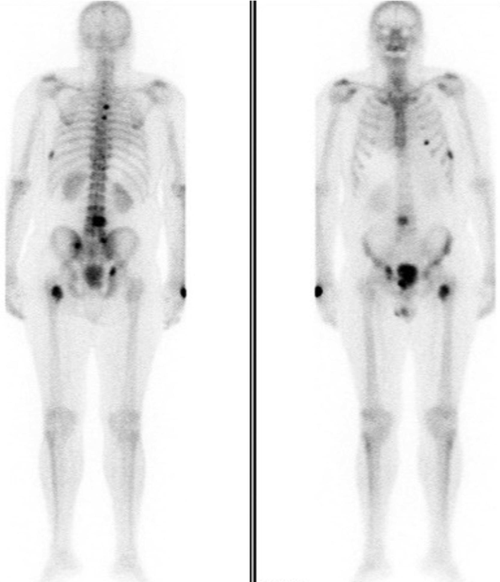 Figure 60.1, Bone scan showing bone metastatic involvement.