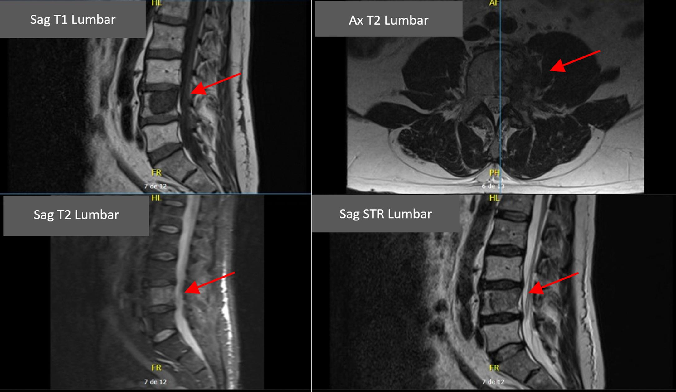 Figure 60.2, Magnetic resonance imaging showing metastatic involvement at the lumbar level (L4).