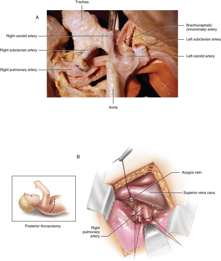 Figure 30-1, Blalock-Taussig Shunt A Right subclavian artery–right pulmonary artery anastomosis (Blalock-Taussig shunt). This specimen demonstrates a perfectly executed Blalock-Taussig shunt. The aorta enters the middle of the image from below. The three arch branches are demonstrated; the brachiocephalic or innominate artery is the first branch and is intact. The left carotid and left subclavian arteries have been divided. The hemostat is on the right carotid artery. The right subclavian artery has been divided after ligating its side branches with hemoclips. The right subclavian artery is turned down to the right pulmonary artery, where anastomosis has been performed with interrupted stitches of fine polypropylene. B A posterolateral thoracotomy incision is made on the side opposite the aortic arch. In most cases the incision is a right thoracotomy. The thorax is entered through the bed of the nonresected fourth rib. The mediastinal pleura is opened from the pulmonary artery parallel to the superior vena cava and over the right subclavian artery. The azygos vein is mobilized, ligated, and divided. The distal ligature on the doubly ligated superior vena cava side of the azygos vein may be used as a traction suture for the vena cava to retract it medially and anteriorly. The right pulmonary artery is completely mobilized, and double-loop tourniquet ligatures are placed on the apical anterior segmental branch and the pars intermedius of the pulmonary artery. The right pulmonary artery is mobilized as far medially as possible. The pericardium is dissected off the right pulmonary artery, preserving the integrity of the pericardial sac. C The right subclavian artery is identified and mobilized. Heparin 100 U/kg is administered intravenously to prevent fibrin formation within the subclavian artery during dissection. A rubber band or vessel loop is passed around the right subclavian artery for atraumatic retraction. The branches in the subclavian artery are ligated and divided. The vagus nerve is identified. A small right-angled clamp is passed beneath the vagus nerve, and the anterior surface of the subclavian artery is mobilized from beneath the nerve. The subclavian artery is ligated. A Cooley vascular clamp is passed beneath the vagus nerve and used to occlude the subclavian artery distally at the ligature. The subclavian artery is divided, and the Cooley clamp is withdrawn from beneath the vagus nerve to remove the subclavian artery from the loop formed by the vagus nerve and its recurrent branch. D With the Cooley clamp on the distal end of the subclavian artery for retraction, the carotid and innominate arteries are completely mobilized from the connective tissue of the mediastinum. Dissection should be taken as far as possible on the carotid artery and as far medially on the innominate artery as possible to obtain maximal mobilization and length of the subclavian artery for approximation to the right pulmonary artery. E A Dietrich vascular clamp is placed on the subclavian artery at its takeoff from the innominate artery. A Blalock vascular clamp is placed across the right pulmonary artery, and tourniquet ligatures on the distal branches of the right pulmonary artery are secured. Using a No. 11 scalpel, an incision is made halfway across the subclavian artery proximal to the occlusion clamp, preserving the appropriate length to reach the right pulmonary artery incision; at the same time, the incision is made as far proximal in the subclavian artery as possible to obtain maximal diameter. F A longitudinal incision is made in the anterior and superior aspects of the right pulmonary artery. The length of the incision should approximate the diameter of the subclavian artery, recognizing that the pulmonary artery incision always enlarges during the course of the anastomosis. G Continuous stitches of 7/0 polypropylene are used to construct a back row in the anastomosis. All the suture loops are placed for this back row before the arteries are approximated. The needle is passed from the lumen or intimal surface out of the subclavian artery and then passed from the adventitial surface of the pulmonary artery into its lumen. The end of the subclavian artery is excised, and an appropriate bevel is fashioned. This step must be performed carefully to preserve length on the anterior surface of the subclavian artery. H The suture loops are then pulled up to approximate the subclavian artery to the pulmonary artery. I The front row of the anastomosis is completed using interrupted stitches. Two stitches are placed initially at each end of the anastomosis to secure the continuous stitch. All interrupted stitches of the front row are placed before any are tied; this ensures the accuracy of the anastomosis and prevents picking up the back row of the anastomosis. Laks-Castaneda Modification J When it is necessary to use the subclavian artery on the same side as the aortic arch, the Laks-Castaneda subclavian aortoplasty may be used to prevent kinking of the subclavian artery over the aortic arch. After complete mobilization of the subclavian artery and the distal portion of the aortic arch, the subclavian artery is ligated and divided. A partial-occlusion vascular clamp is placed on the distal aortic arch to exclude the base of the subclavian artery. An incision is made in the base of the subclavian artery, extending distally on the artery and into the aortic arch, opposite the base of the artery. This longitudinal incision is closed in a transverse fashion using fine polypropylene suture in continuous stitches. This suture line transplants the subclavian orifice onto the anterior wall of the aortic arch so that the subclavian artery is directed toward the pulmonary artery without distortion or kinking. K The anastomosis of the distal end of the subclavian artery to the pulmonary artery is constructed by partial exclusion of the pulmonary artery using a technique similar to that described for the standard Blalock-Taussig shunt. Modified Blalock-Taussig Shunt L A modification of the Blalock-Taussig shunt principle, in which a prosthetic graft is interposed between the subclavian and pulmonary arteries, combines simplicity of performance, favorable blood flow characteristics controlled by the size of the subclavian artery, lack of distortion of the pulmonary artery, and preservation of subclavian artery blood flow. The operation may not be perfect for long-term palliation, but it is satisfactory when palliation for less than 2 years is required. The shunt is performed on the same side as the aortic arch, in most instances through a posterolateral thoracotomy. For patients with the usual left arch anatomy, the left subclavian artery and the proximal portion of the left pulmonary artery are mobilized. A small, curved vascular clamp is used to isolate the left subclavian artery just distal to its origin. A 4- or 5-mm polytetrafluoroethylene (PTFE) graft is beveled to fit the side of the subclavian artery and is directed toward the proximal pulmonary artery. An end-to-side anastomosis of the graft to the subclavian artery is constructed by continuous stitches with 6/0 or 7/0 polypropylene. M The vascular clamp is used to isolate a portion of the left pulmonary artery. The graft is then beveled appropriately to approximate the pulmonary artery. An end-to-side anastomosis of the graft to the pulmonary artery is constructed by continuous stitches using fine polypropylene suture.