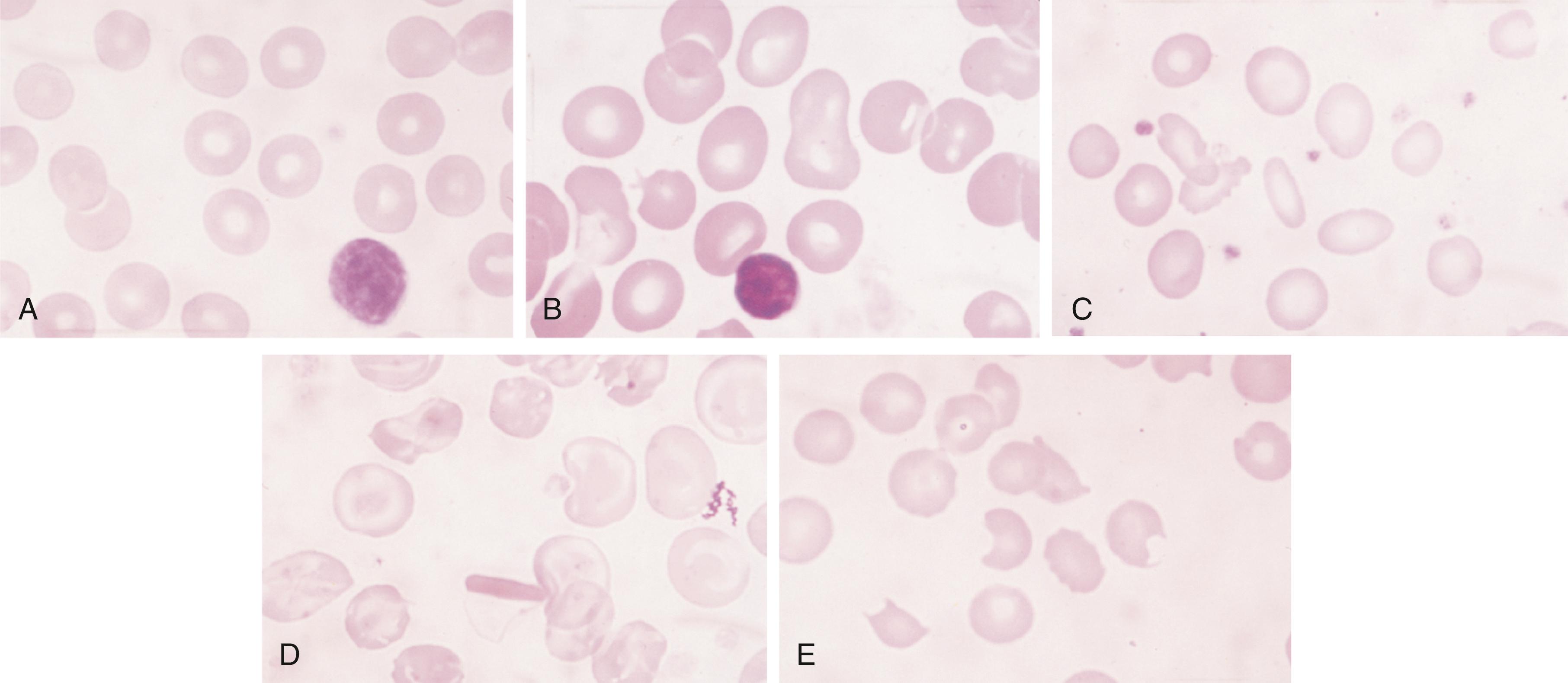 Fig. 49.2, Morphologic abnormalities of the red blood cell. A, Normal. B, Macrocytes. C, Hypochromic microcytes. D, Target cells. E, Schizocytes.