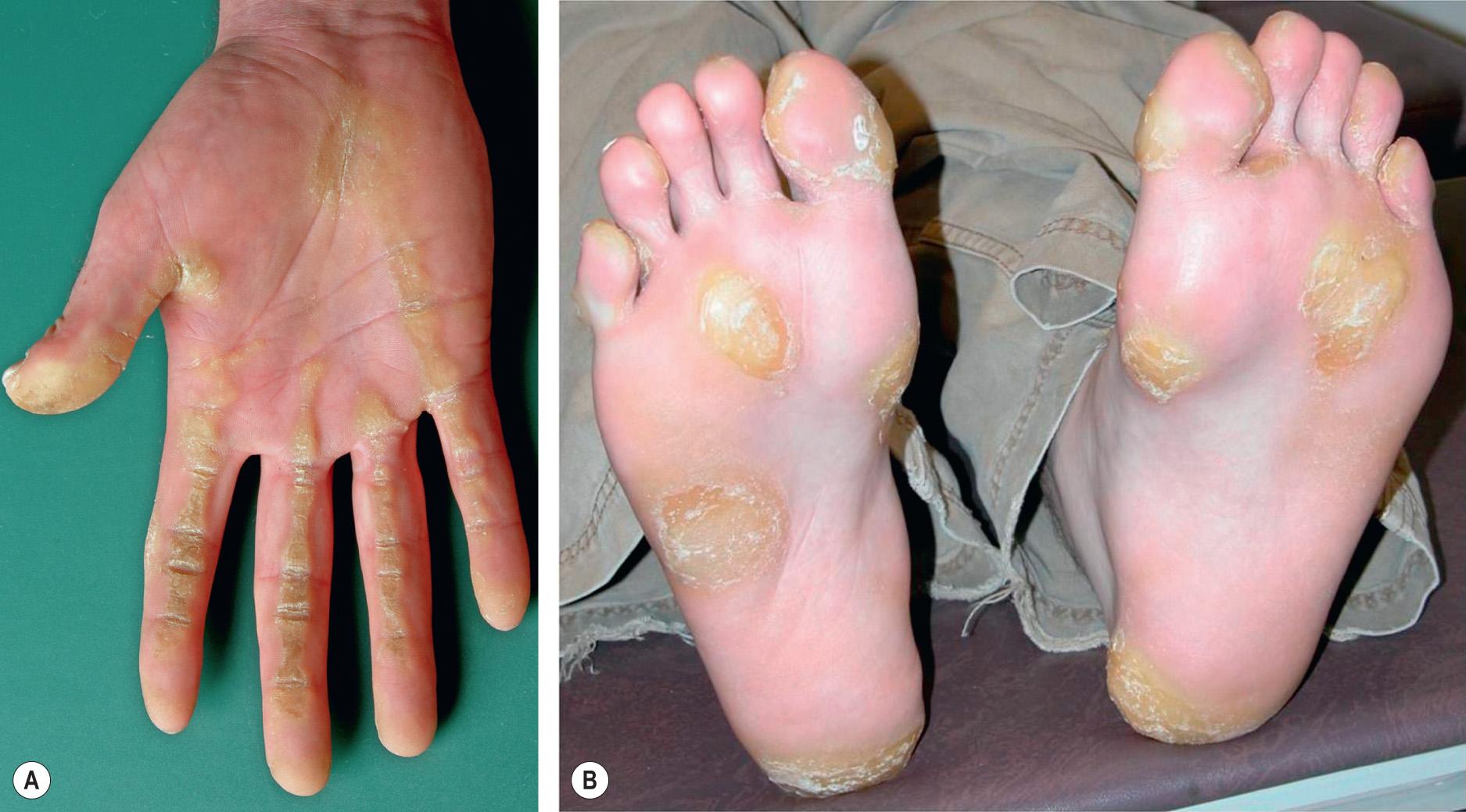 Fig. 58.2, Focal palmoplantar keratoderma.