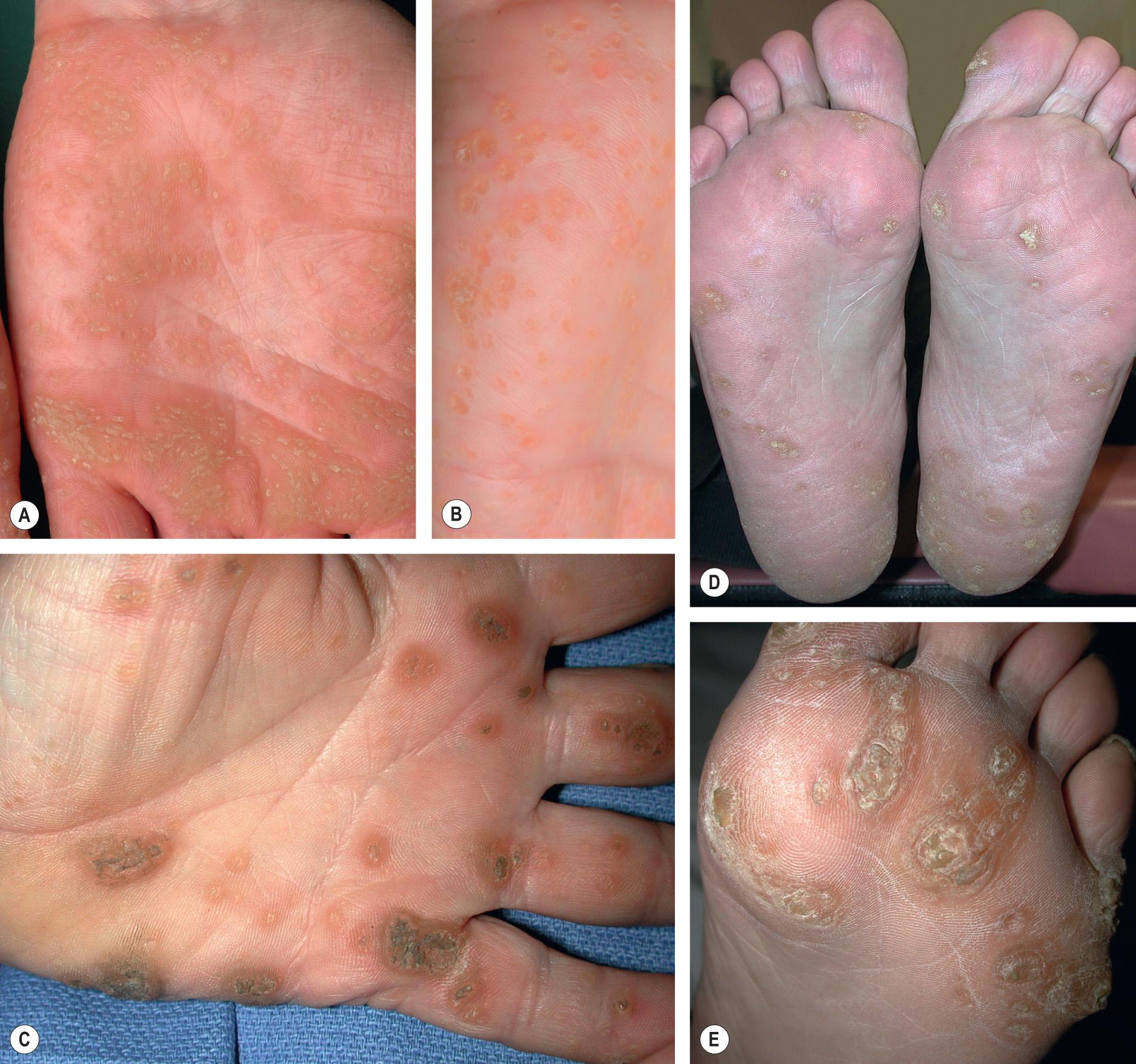 Fig. 58.3, Punctate palmoplantar keratoderma.