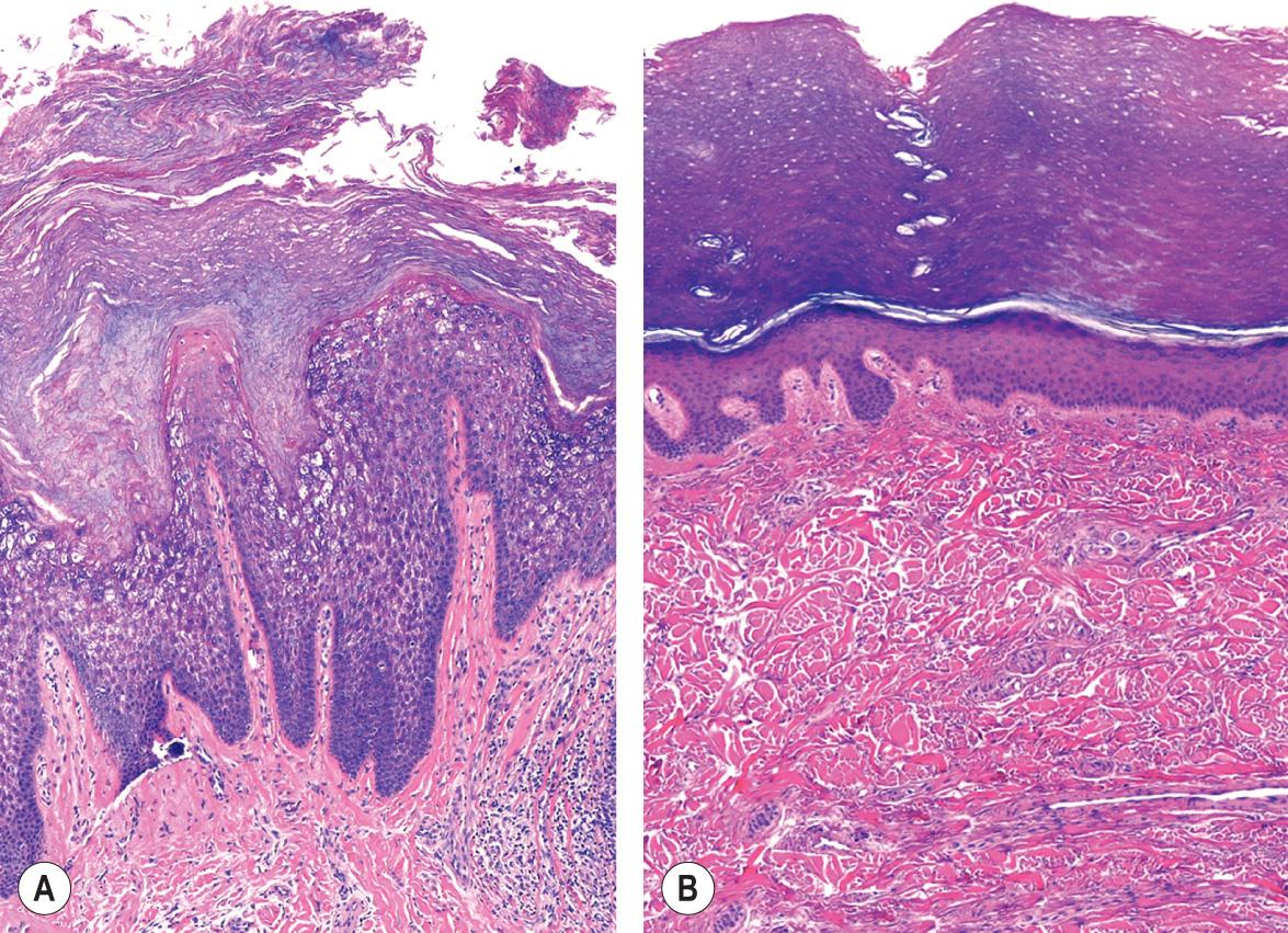 Fig. 58.6, Histologic features of palmoplantar keratoderma.