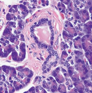 Figure 22.1, Normal pancreatic acini consist of tubular glands with round, basally located nuclei and prominent granules. A small duct is in the center of the photograph.