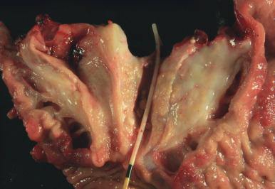 Figure 22.11, Both the pancreatic duct (stented) and the common bile duct are dilated, and there is extensive scarring of the paraduodenal pancreas in this case of paraduodenal pancreatitis.