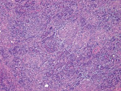Figure 22.12, Numerous epithelioid, noncaseating granulomas in a case of pancreatic involvement by sarcoidosis.