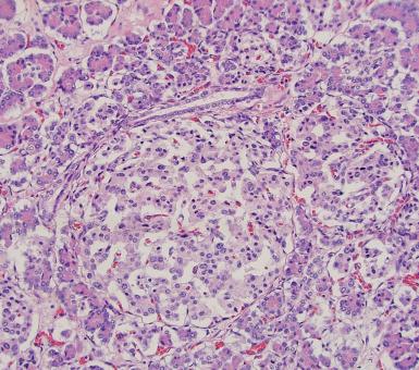 Figure 22.3, Hypertrophic, irregular islet with closely approximated duct (ductuloinsular complex) in a case of hyperinsulinemic hypoglycemia.