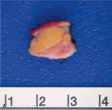 Figure 22.4, A, Firm lobules of heterotopic pancreatic tissue are visible in this resection specimen from the stomach. B, Endoscopically, there is often central umbilication, corresponding to the duct that opens in the small bowel lumen. C, Low-power view of heterotopic pancreas in small bowel; both acinar tissue and ducts are easily identified. D, Higher-power view of heterotopic pancreatic acinar tissue and small ducts; the specimen was from the duodenum.