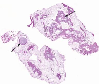 Figure 22.5, This case of cystic fibrosis shows fatty replacement of pancreatic parenchyma, cyst formation, and dilated ducts containing inspissated eosinophilic secretions ( arrows).