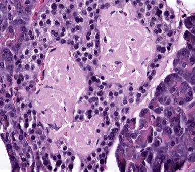 Figure 22.6, Islet cell amyloidosis in a patient with type 2 diabetes.