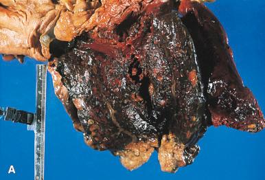 Figure 22.7, A, Extensive hemorrhagic necrosis of the pancreas spreads into the surrounding mesentery. B, A higher-power photograph from another case shows hemorrhagic acute pancreatitis with numerous foci of fat necrosis (arrows) . C, Hemorrhagic pancreatitis with large foci of fat necrosis extending into the mesenteric fat. D, Acute necrotizing pancreatitis with extensive hemorrhage and fat necrosis. There is no longer any recognizable pancreatic parenchyma.