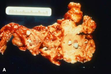 Figure 22.8, A, Alcoholic pancreatitis featuring large, irregular areas of fibrosis and calculi within dilated ducts. B, Another case shows diffuse fibrosis of the pancreas associated with stenosis and increased tortuosity of the main pancreatic duct. C, Close-up of another case of chronic pancreatitis, showing fibrosis and cystic dilation of ducts, some of which are occupied by a grumous secretory material.