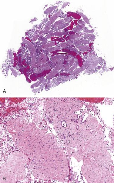 Fig. 14.1, (A) This whole-mount image illustrates the tissue yield with a fork-tipped core needle biopsy of a desmoplastic stroma-dominant ductal carcinoma. (B) A rare focus of invasive carcinoma is noted at high magnification, allowing for a definitive diagnosis of malignancy (A and B, hematoxylin and eosin stain).