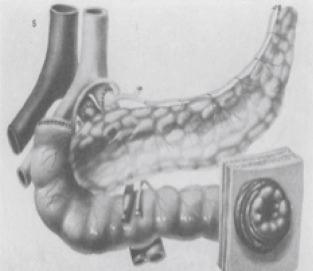 Fig. 36.1, A historical technique used for pancreatico-duodenal transplantation, now seldom used. Exocrine drainage of grafts using a cutaneous duodenostomy.