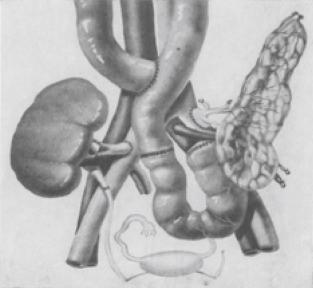 Fig. 36.2, Another historical technique employing enteric drainage via a Roux en Y limb of recipient bowel. Note the long donor duodenum and end to end anastomosis to native jejunum