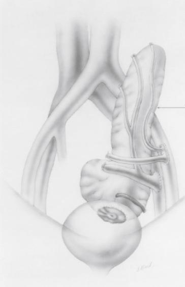 Fig. 36.3, A historical technique using duodenal bulb bladder drainage technique.