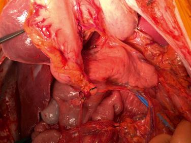 Fig. 36.5, Example of a high quality pancreas at time of organ recovery, note the color and absence of fatty infiltration of the organ.