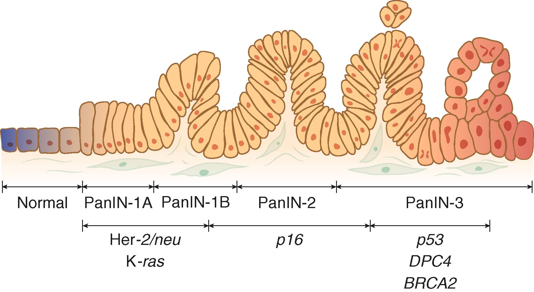 FIGURE 180-1, Genetic progression model of pancreatic adenocarcinoma.