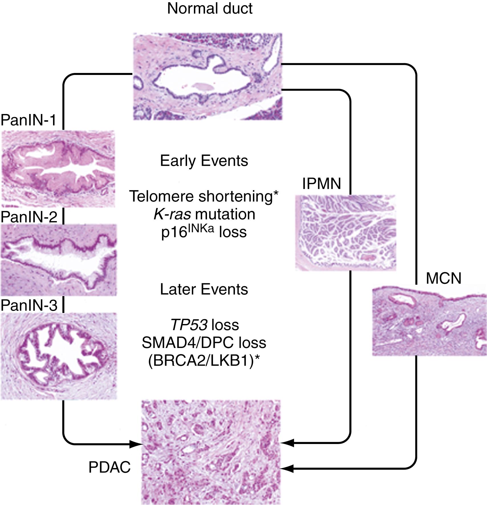 Fig. 60.2, Pancreatic precursor lesions and genetic events involved in pancreatic progression to adenocarcinoma. Pictured are 3 known human pancreatic ductal adenocarcinoma (PDAC) precursor lesions: PanIN, MCN, and IPMN. The PanIN grading scheme is shown on the left ; increasing grades (1 through 3) reflect increasing atypia, eventually leading to frank PDAC. The right side illustrates the potential progression of MCN and IPMN to PDAC. The genetic alterations documented in pancreatic adenocarcinomas also occur in PanIN, and to a lesser extent in MCN and IPMN, in an apparent temporal sequence, although these alterations have not been correlated with the acquisition of specific histopathologic features. The various genetic events are listed and divided into those that occur predominantly early or late in PDAC progression. Asterisks indicate events that are not common to all precursor lesions (e.g., telomere shortening and BRCA2 loss are documented in PanIN, and LKB1 loss is documented in a subset of PDACs and IPMNs). IPMN , intraductal papillary mucinous neoplasm; MCN , mucinous cystic neoplasm; PanIN , pancreatic intraepithelial neoplasia.