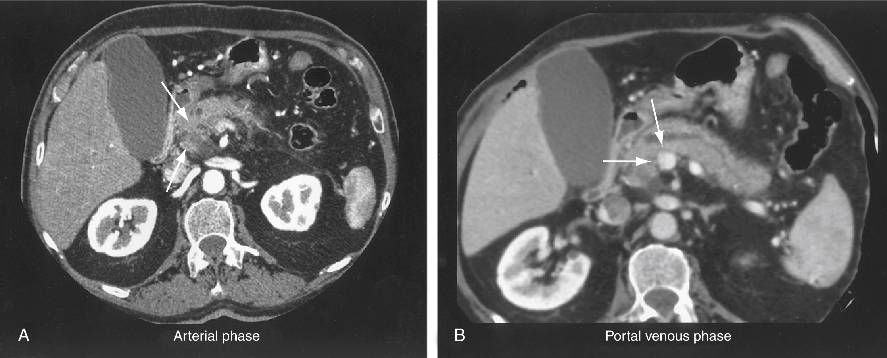 Fig. 60.3, Pancreatic CT protocol in a patient with pancreatic cancer. A, Arterial phase showing a nonenhancing lesion in the head of the pancreas ( arrows ). B, Venous phase showing a noninvolved fat plane around the portal vein ( arrows ).