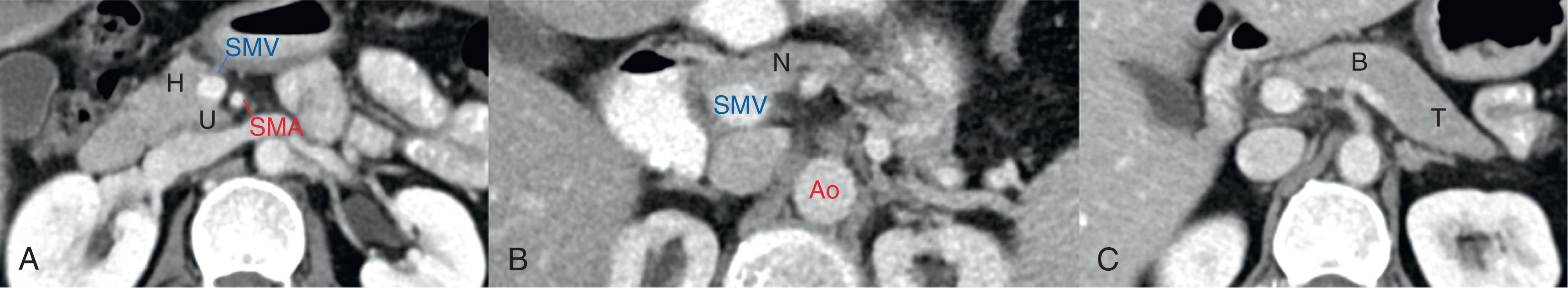 Figure 12.1, Pancreatic anatomy on axial cross-sectional contrast enhanced multidetector row computed tomography. A , Inferior pancreas. H , Head; SMA , superior mesenteric artery; SMV , superior mesenteric vein; U , uncinate. B , Superiorly, the neck (N). C , Further cranially, the pancreatic body (B) and tail (T). Ao ; Aorta.