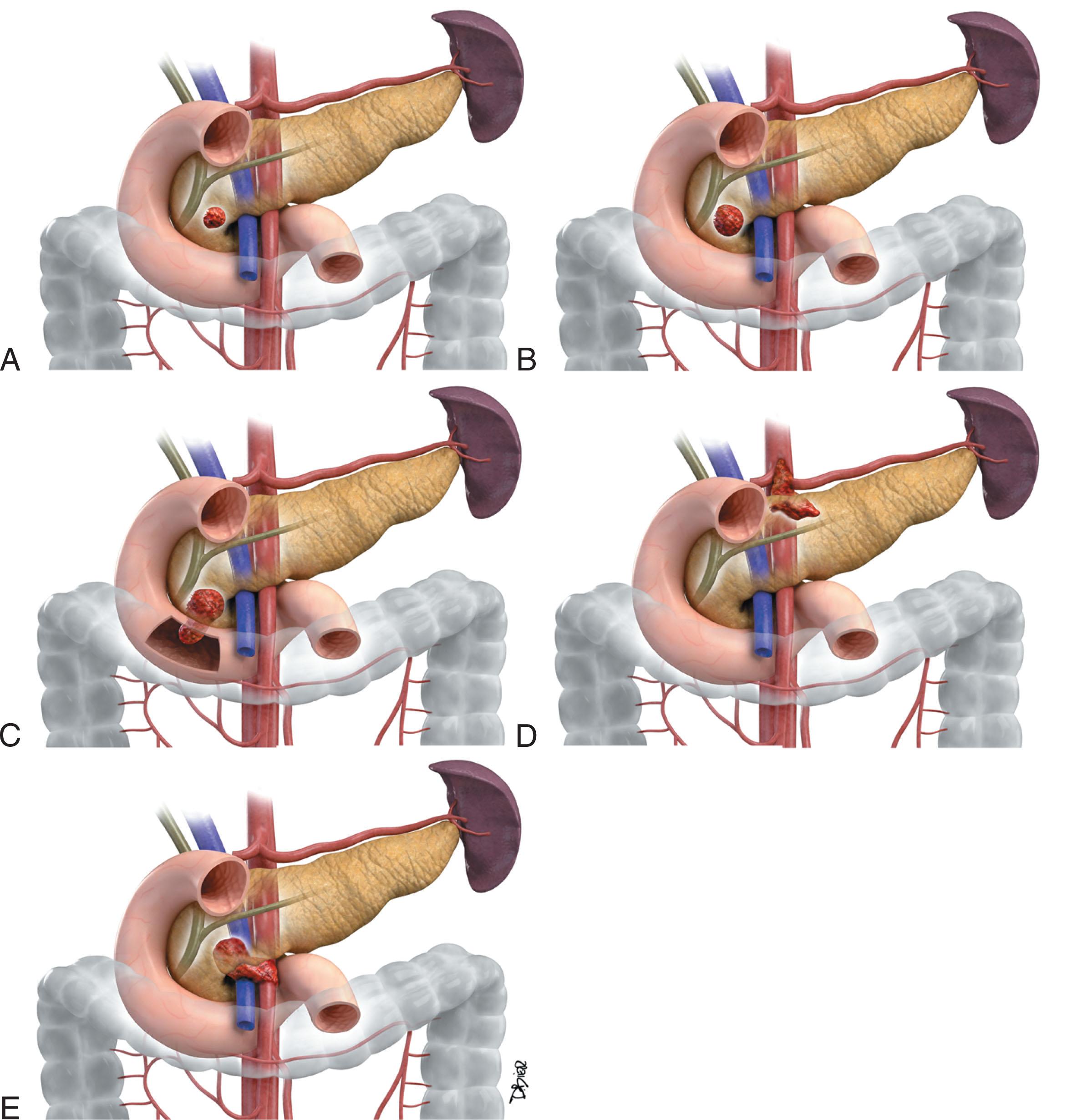 Figure 12.2, T staging. A , T1, tumors are limited to the pancreas but less than or equal to 2 cm. B , T2 is between 2.1 and 4 cm in diameter but still confined to the pancreas. C , T3 extends beyond the pancreas without involving the celiac or superior mesenteric arteries. D and E , T4 tumors involve the celiac axis, superior mesenteric artery, or common hepatic artery.