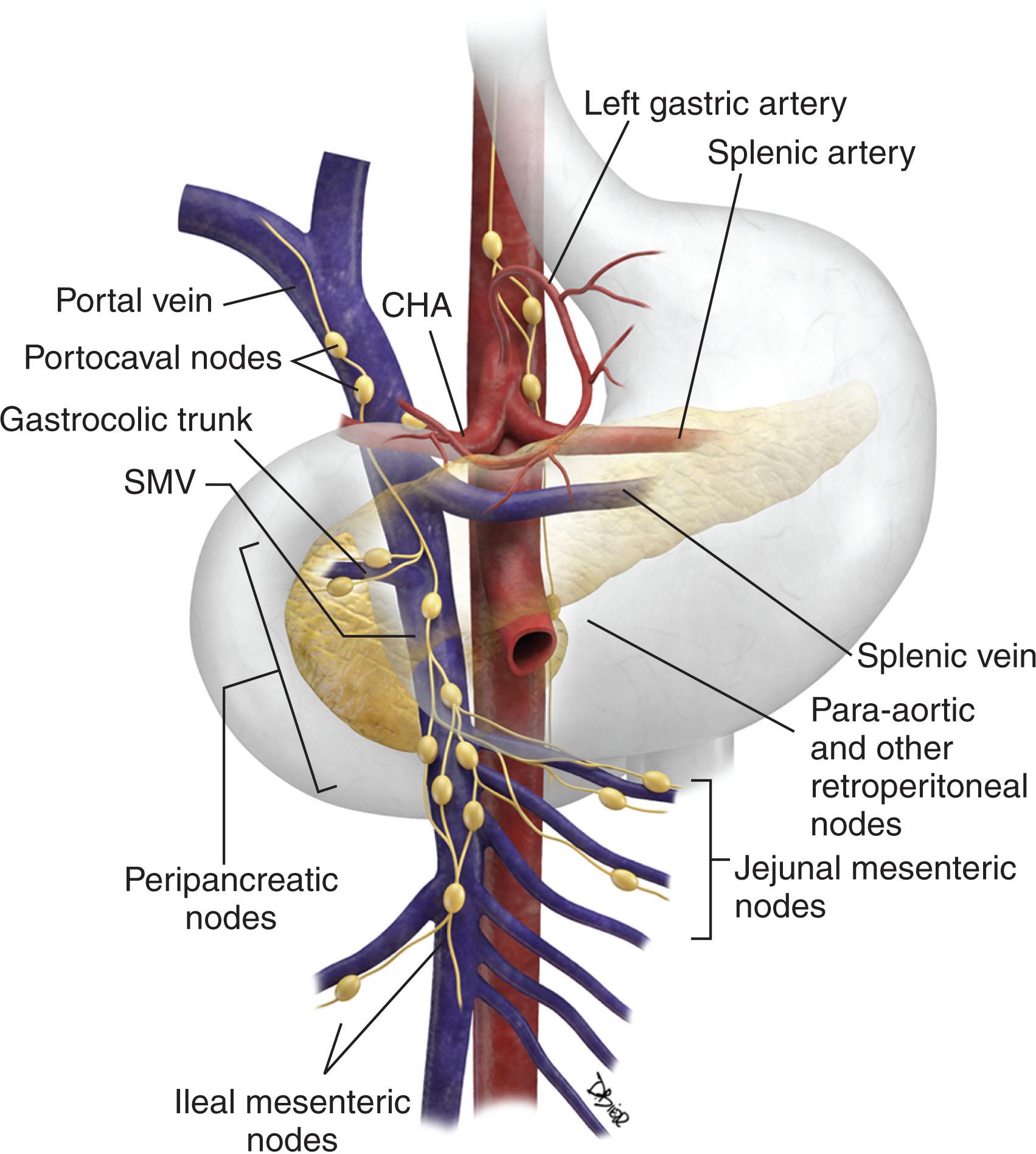 Figure 12.3, Nodal sites. Sites of pancreatic adenocarcinoma nodal involvement include near the left gastric artery, common hepatic artery, portal vein (portacaval region), retroperitoneal, periceliac, peripancreatic, along the gastrocolic trunk, and along the jejunal and ileocolic mesenteric regions. CHA , Common hepatic artery; SMV , superior mesenteric vein.