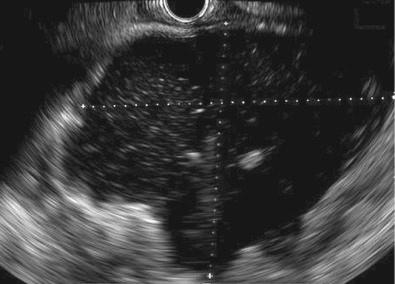 FIG 58.1, Endosonographic image of mature walled-off necrosis.