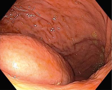 FIG 58.2, Luminal bulge from an extrinsically compressing pancreatic fluid collection (PFC).