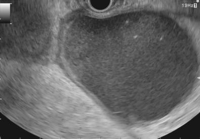 FIG 58.3, Endosonographic image of a mature pseudocyst.