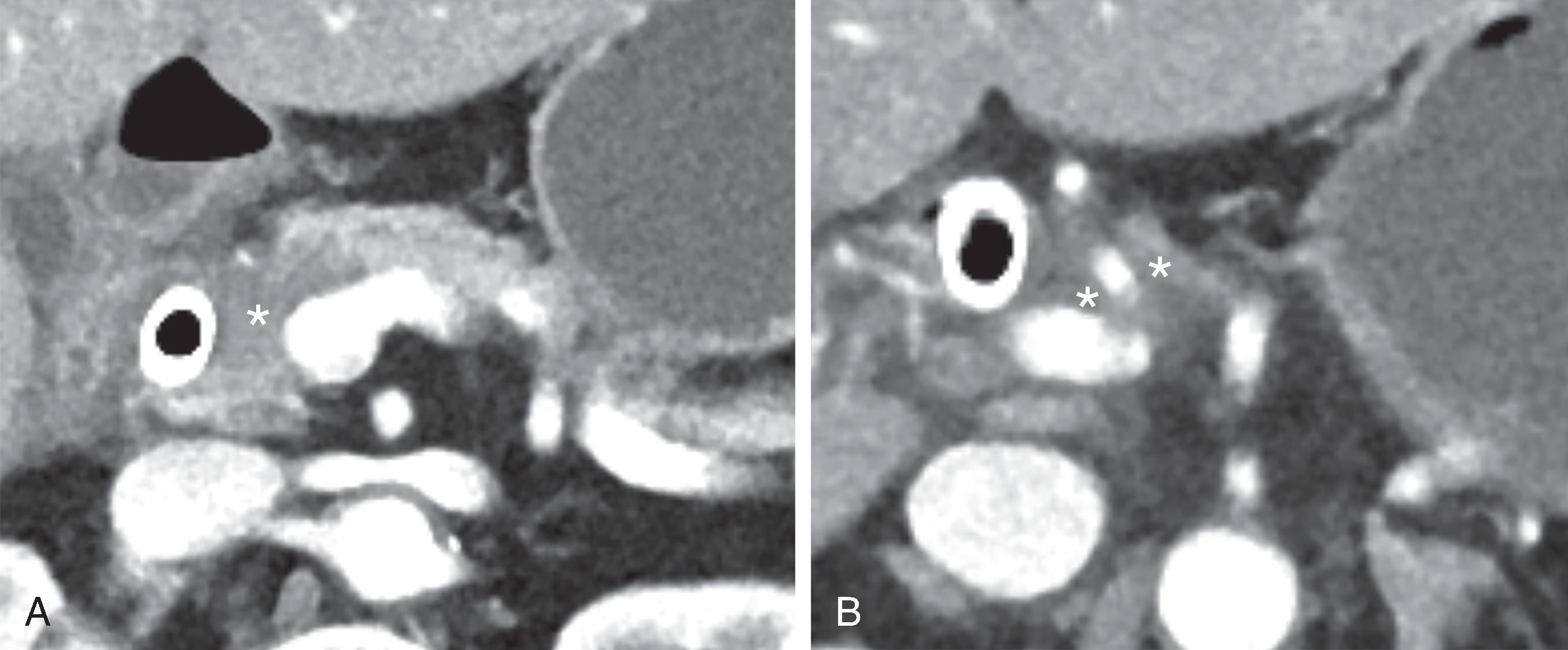 Fig. 60.1, Pancreatic adenocarcinoma.