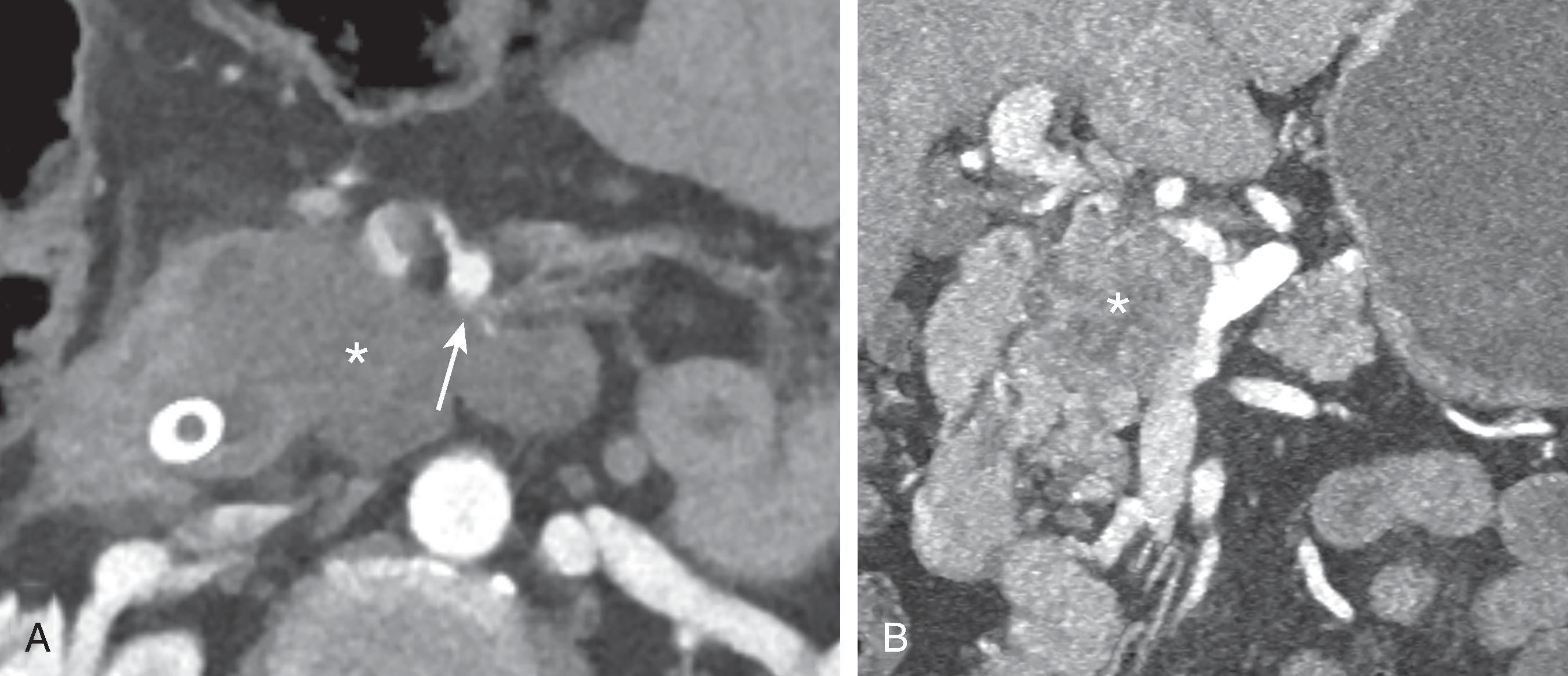 Fig. 60.2, Locally advanced pancreatic adenocarcinoma.