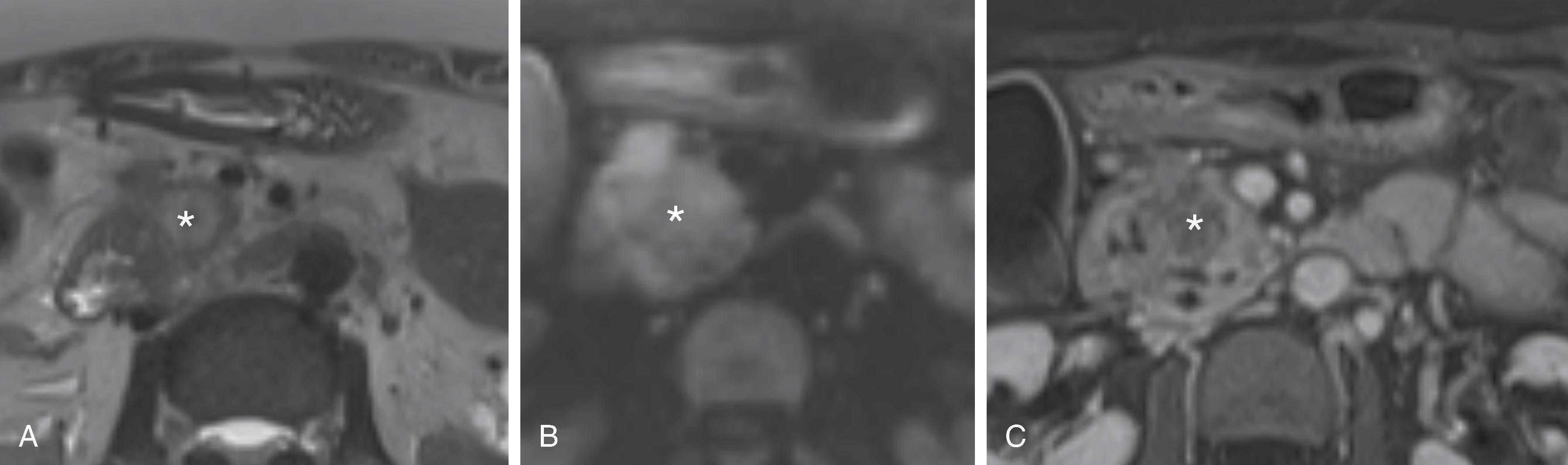 Fig. 60.3, Pancreatic adenocarcinoma: magnetic resonance imaging assessment.