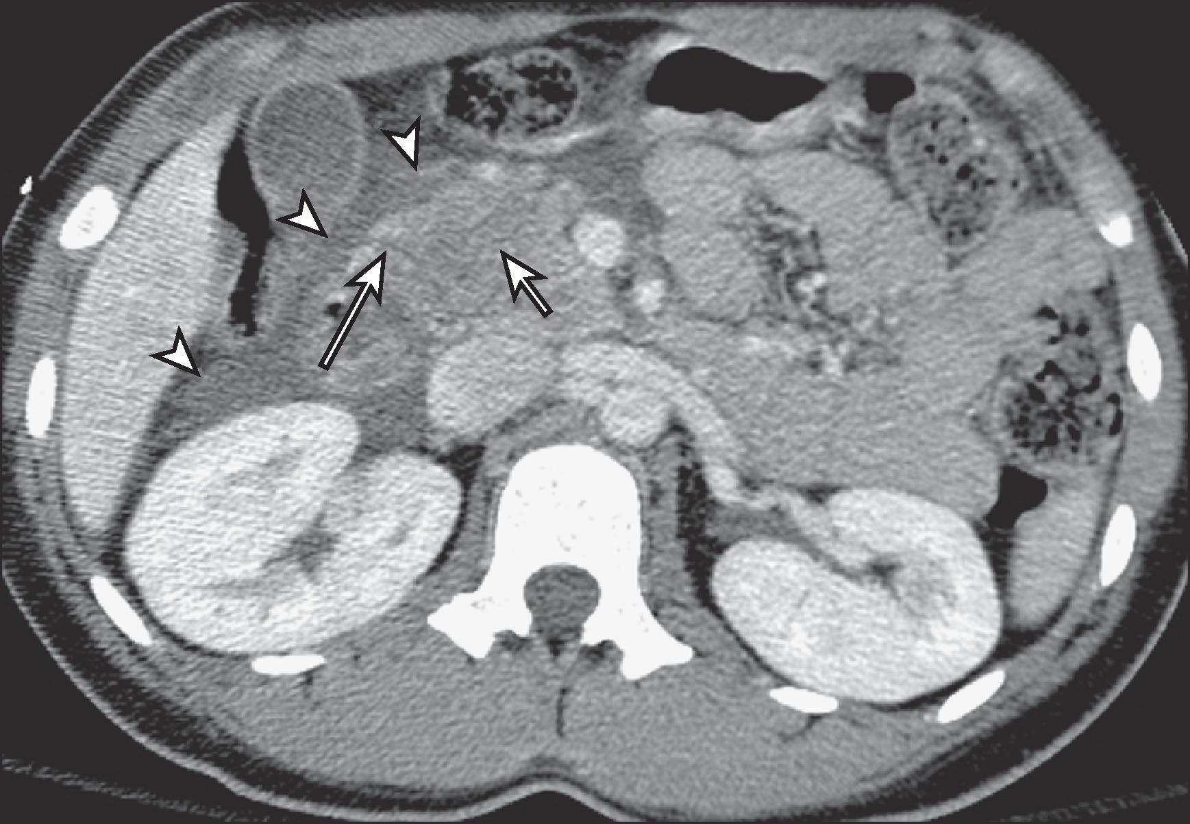 Fig. 61.1, Computed tomography (CT) findings in pancreatic contusion.