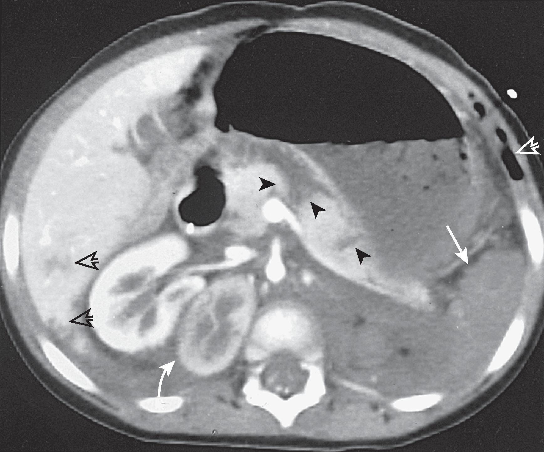 Fig. 61.3, Pancreatic lacerations and multiorgan injury.