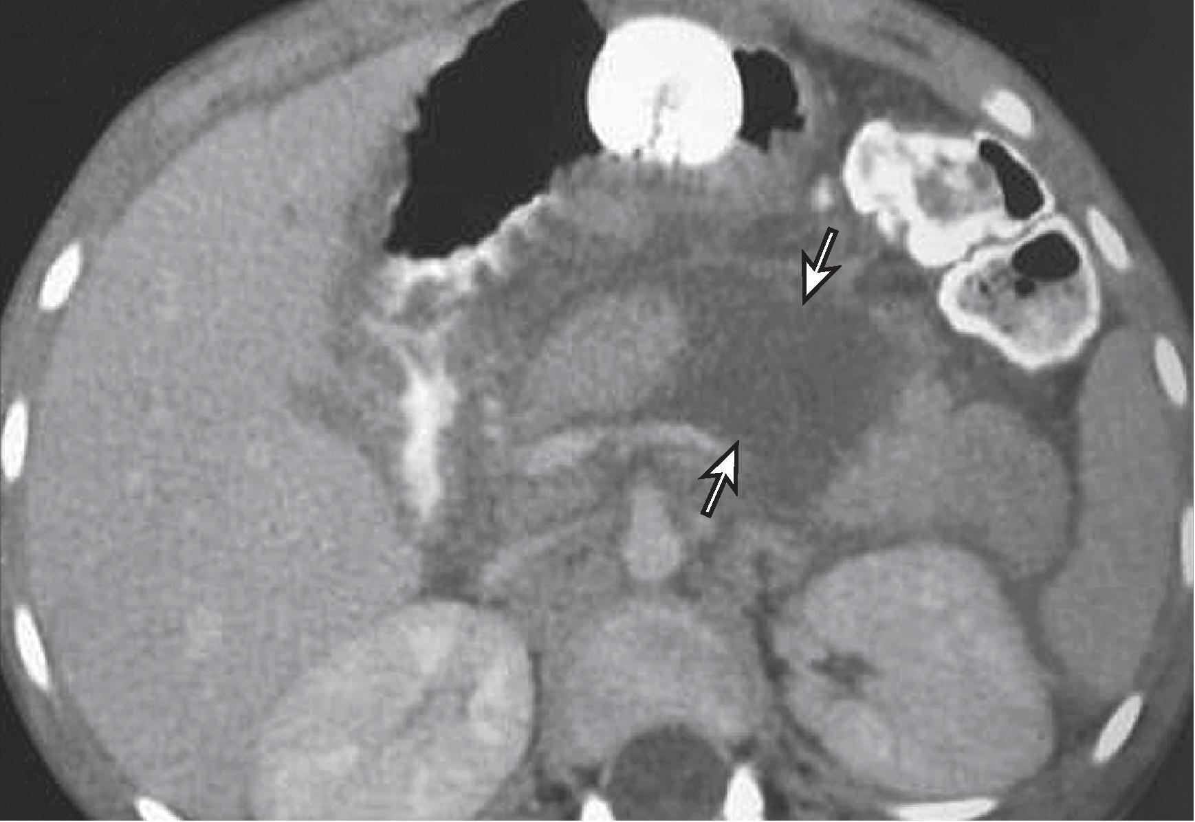 Fig. 61.4, Computed tomography (CT) findings in pancreatic transection.